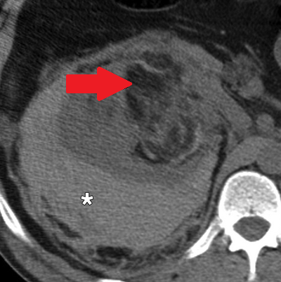 Αυτόματη αιμορραγία αριστερού επινεφριδίου (Ευγενική παραχώρηση Dr. V. Penopoulos)