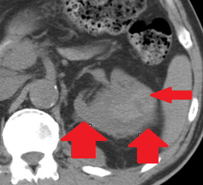 Αυτόματη αιμορραγία αριστερού επινεφριδίου (Ευγενική παραχώρηση Dr. V. Penopoulos)