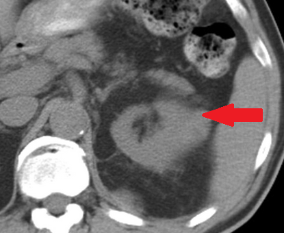 Αυτόματη αιμορραγία αριστερού επινεφριδίου (Ευγενική παραχώρηση Dr. V. Penopoulos)