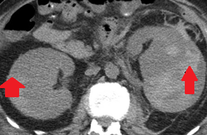 Αυτόματη αιμορραγία αριστερού επινεφριδίου (Ευγενική παραχώρηση Dr. V. Penopoulos)