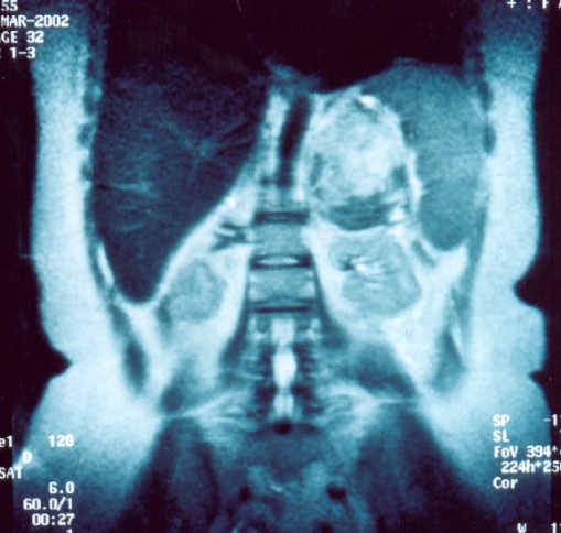 Αυτόματη αιμορραγία αριστερού επινεφριδίου (Ευγενική παραχώρηση Dr. V. Penopoulos)