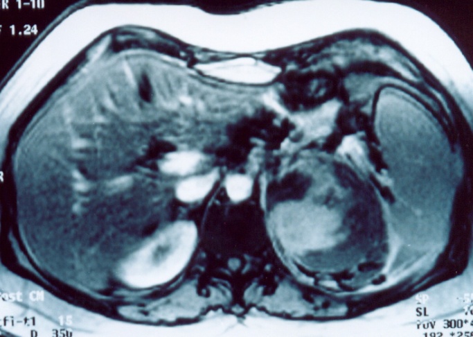 Αυτόματη αιμορραγία αριστερού επινεφριδίου (Ευγενική παραχώρηση Dr. V. Penopoulos)