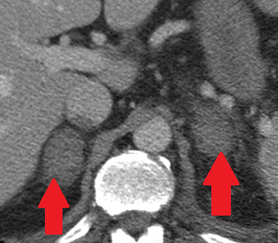 Αμφοτερόπλευρη αιμορραγία επινεφριδίων (Ευγενική παραχώρηση Dr. V. Penopoulos)