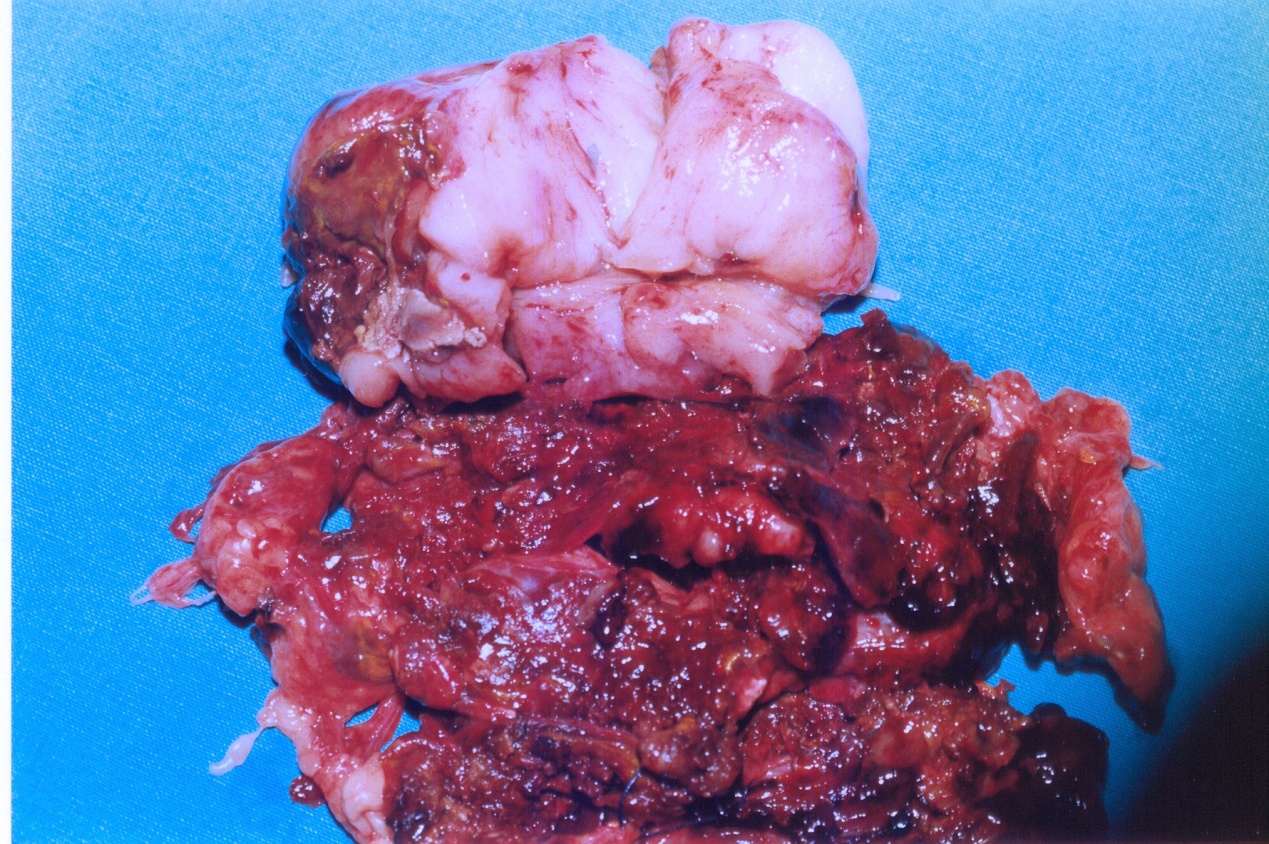 Αριστερή επινεφριδεκτομή μετά από αυτόματη αιμορραγία σε μεταμοσχευμένο αιματολογικό ασθενή (Ευγενική παραχώρηση Dr. V. Penopoulos)