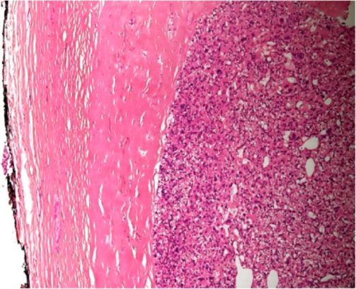 Thick capsule. A characteristic feature of both atypical parathyroid adenoma and parathyroid carcinoma (Courtesy Dr. V. Penopoulos)