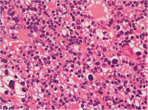Ki-67+ > 4%: immunohistochemical staining for Ki-67 highlights the high mitotic index in the atypical parathyroid adenoma (Courtesy Dr. V. Penopoulos)