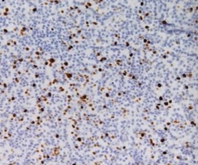 Ki-67+ > 4%: immunohistochemical staining for Ki-67 highlights the high mitotic index in the atypical parathyroid adenoma (Courtesy Dr. V. Penopoulos)