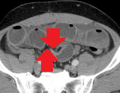 Red arrows — transition point. Multiple air-fluid levels (Courtesy Dr. V. Penopoulos)