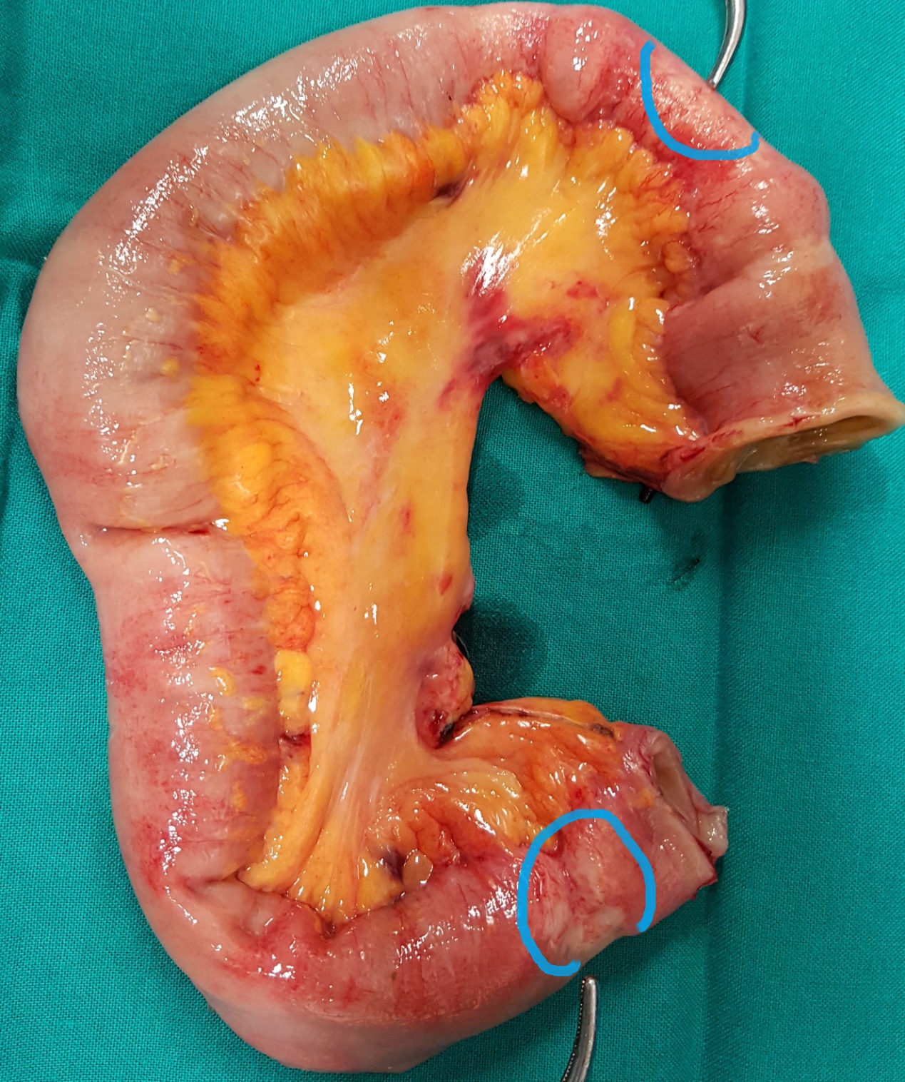 Resected obstructed ileal loop. Blue circles enclose the metastatic foci (Courtesy Dr. V. Penopoulos)