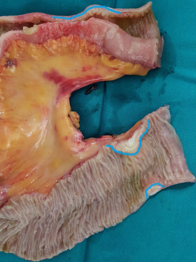 After opening the specimen, the metastatic foci are clearly visible (Courtesy Dr. V. Penopoulos)