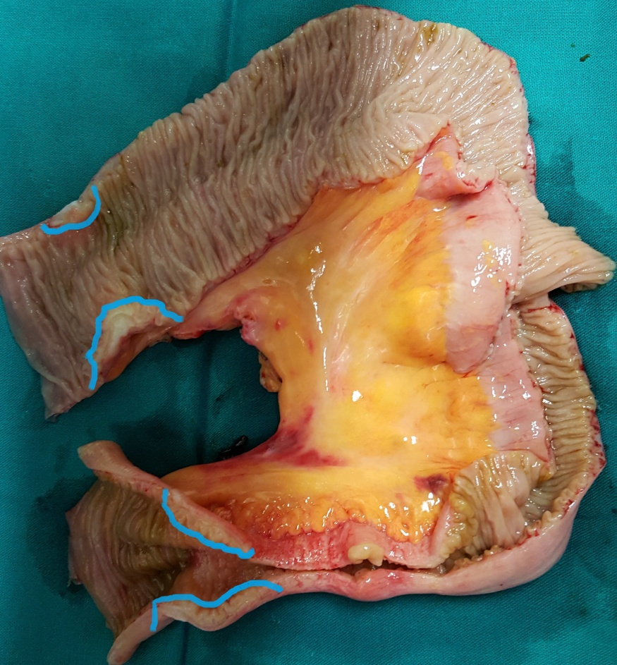 The two metastatic foci causing stenosis and bowel obstruction are clearly visible (Courtesy Dr. V. Penopoulos)
