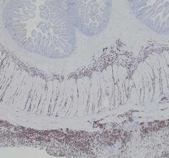Immunohistochemical staining for Cytokeratin 7, demonstrating the diffusely infiltrating carcinoma in the submucosa, muscular wall, mesenteric adipose tissue, and serosa (Courtesy Dr. V. Penopoulos)