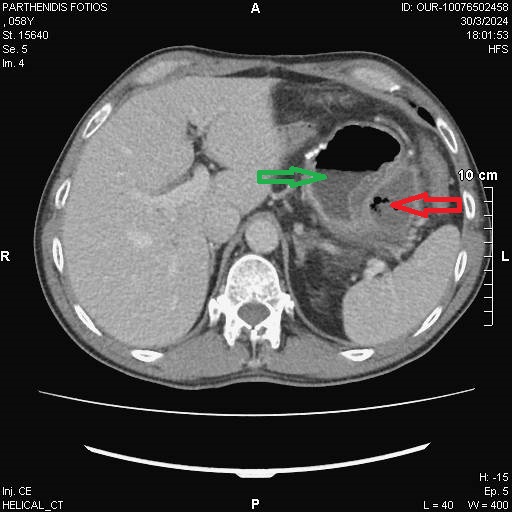 Πράσινο βέλος — Στόμαχος. Κόκκινο βέλος — Απόστημα (Ευγενική παραχώρηση Dr. V. Penopoulos).