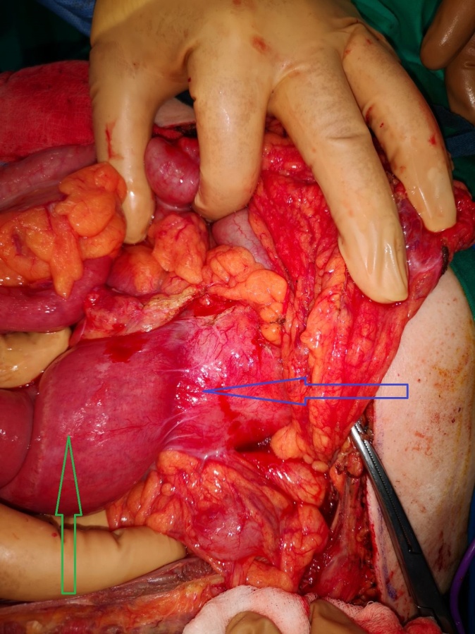 Πράσινο βέλος — Εγγύς νήστιδα. Μπλε βέλος — Απόστημα (Ευγενική παραχώρηση Dr. V. Penopoulos).