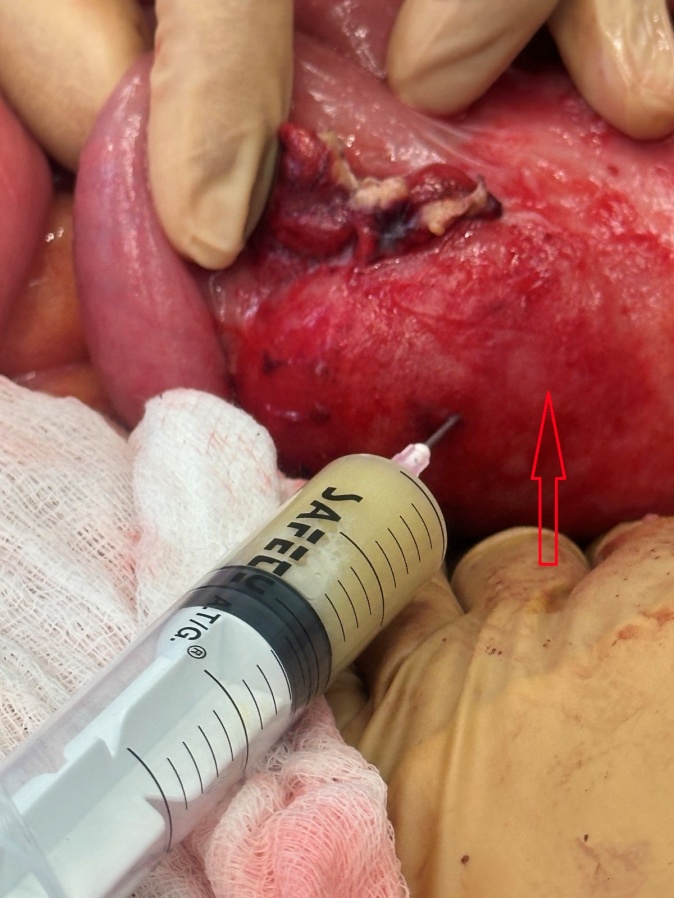 Παρακέντηση του αποστήματος (Ευγενική παραχώρηση Dr. V. Penopoulos).