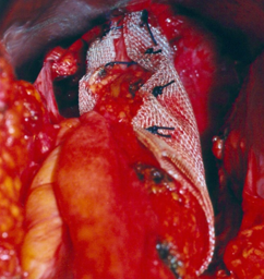 Τροποποιημένη οπίσθια ορθοπηξία κατά Wells (Ευγενική παραχώρηση Dr. V. Penopoulos)