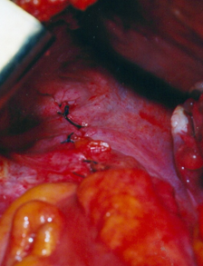 Περιτοναϊκή κάλυψη της ορθοπηξίας (Ευγενική παραχώρηση Dr. V. Penopoulos)