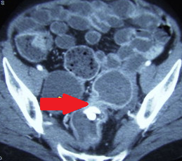 CT κοιλίας. Διάβρωση/μετανάστευση του πλέγματος εντός του ορθού (Ευγενική παραχώρηση Dr. V. Penopoulos)