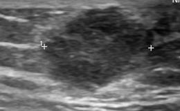 Ορατή διήθηση των μασχαλιαίων λεμφαδένων (Ευγενική παραχώρηση Dr. V. Penopoulos)