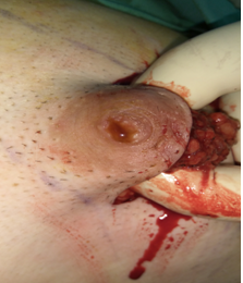 Ορατή διήθηση των μασχαλιαίων λεμφαδένων (Ευγενική παραχώρηση Dr. V. Penopoulos)