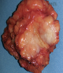 Ορατή διήθηση των μασχαλιαίων λεμφαδένων (Ευγενική παραχώρηση Dr. V. Penopoulos)