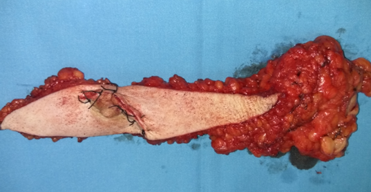 Ορατή διήθηση των μασχαλιαίων λεμφαδένων (Ευγενική παραχώρηση Dr. V. Penopoulos)