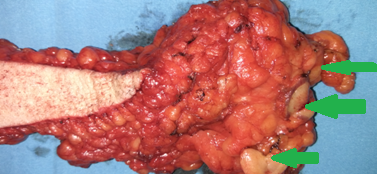 Ορατή διήθηση των μασχαλιαίων λεμφαδένων (Ευγενική παραχώρηση Dr. V. Penopoulos)