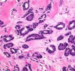 Ψηφιακή μαστογραφία. Θηλώδες καρκίνωμα ανδρικού μαστού (Ευγενική παραχώρηση Dr. V. Penopoulos)