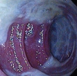 Ενδοσκοπική εικόνα της θήκης. Παρουσία μεγάλων ποσοτήτων βλέννας και ψευδομεμβρανών (Ευγενική παραχώρηση Dr. V. Penopoulos)