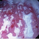 Ενδοσκοπική εικόνα της θήκης. Παρουσία μεγάλων ποσοτήτων βλέννας και ψευδομεμβρανών (Ευγενική παραχώρηση Dr. V. Penopoulos)