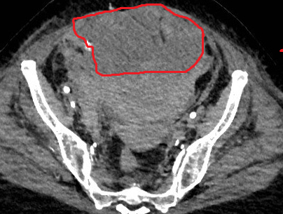 CT. Σημαντικό αιμάτωμα εκτεινόμενο στον προκυστικό χώρο (Ευγενική παραχώρηση Dr. V. Penopoulos).