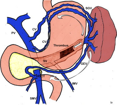 Abdominal CT scan. Visible presence of varices at the hilum of the spleen (Courtesy Dr. V. Penopoulos)
