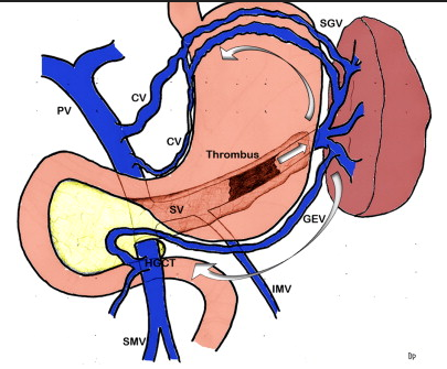 Varices at the hilum of the spleen (Courtesy Dr. V. Penopoulos)