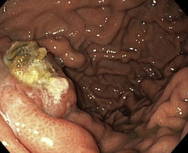 Endoscopic image after performance of splenectomy. Complete disappearance of the varices of the fundus of the stomach (Courtesy Dr. V. Penopoulos)
