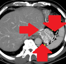 Endoscopic image after performance of splenectomy. Complete disappearance of the varices of the fundus of the stomach (Courtesy Dr. V. Penopoulos)