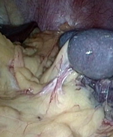 Endoscopic image after performance of splenectomy. Complete disappearance of the varices of the fundus of the stomach (Courtesy Dr. V. Penopoulos)