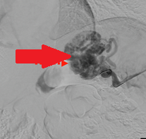 Endoscopic image after performance of splenectomy. Complete disappearance of the varices of the fundus of the stomach (Courtesy Dr. V. Penopoulos)