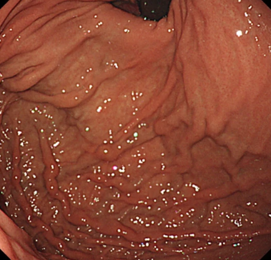 Endoscopic image after performance of splenectomy. Complete disappearance of the varices of the fundus of the stomach (Courtesy Dr. V. Penopoulos)