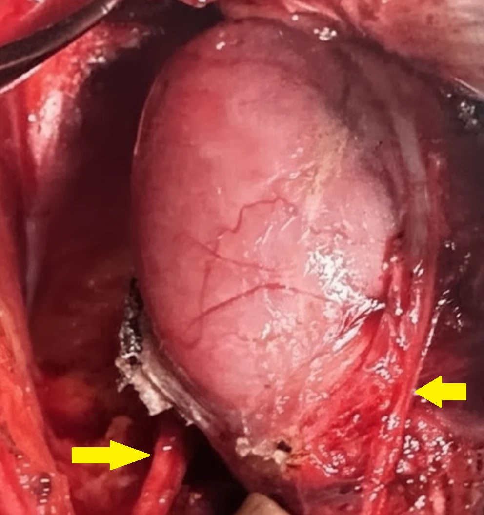 ENUCLEATION ESOPHAGEAL FIBROMA