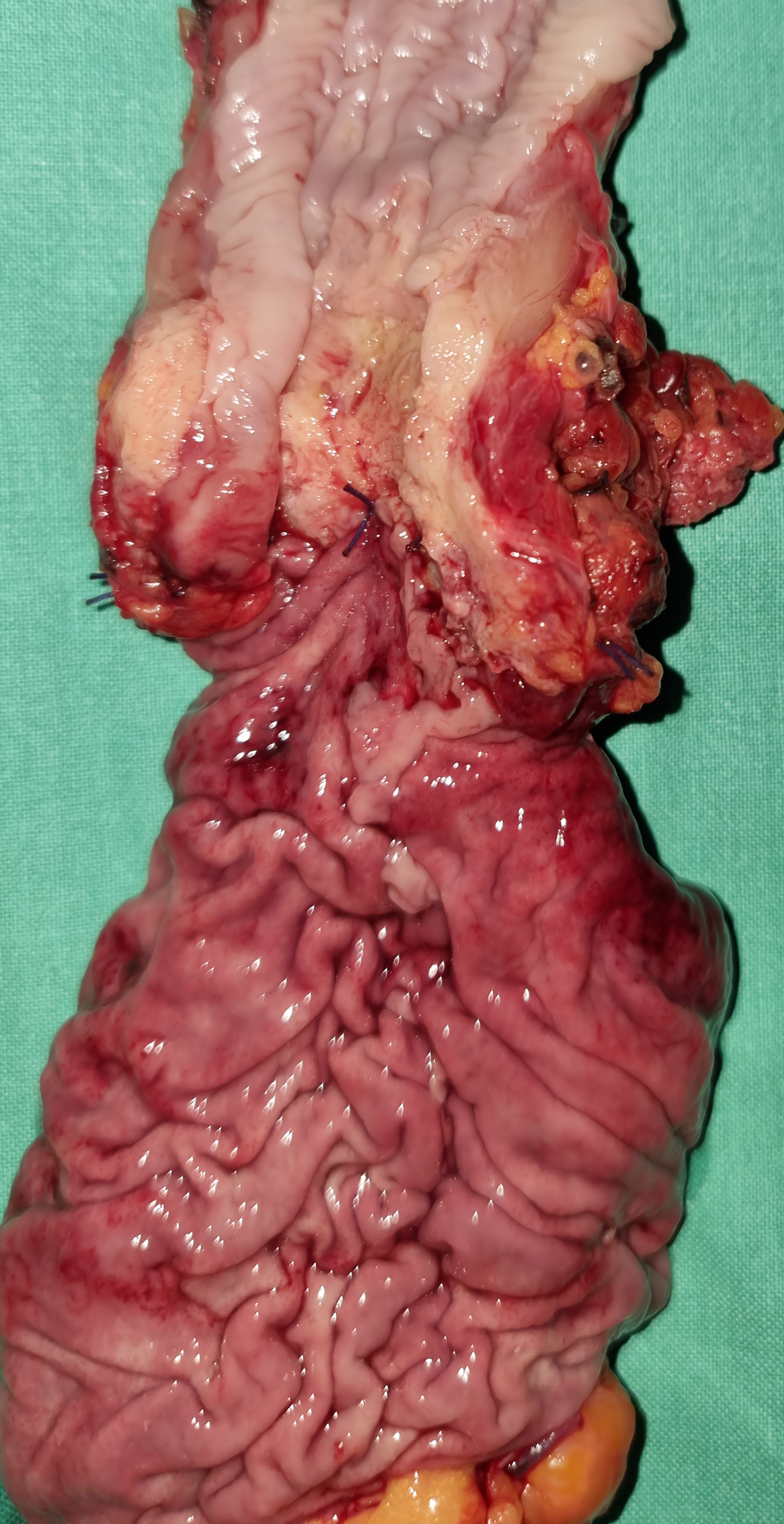 ESOPHAGEAL CARCINOMA