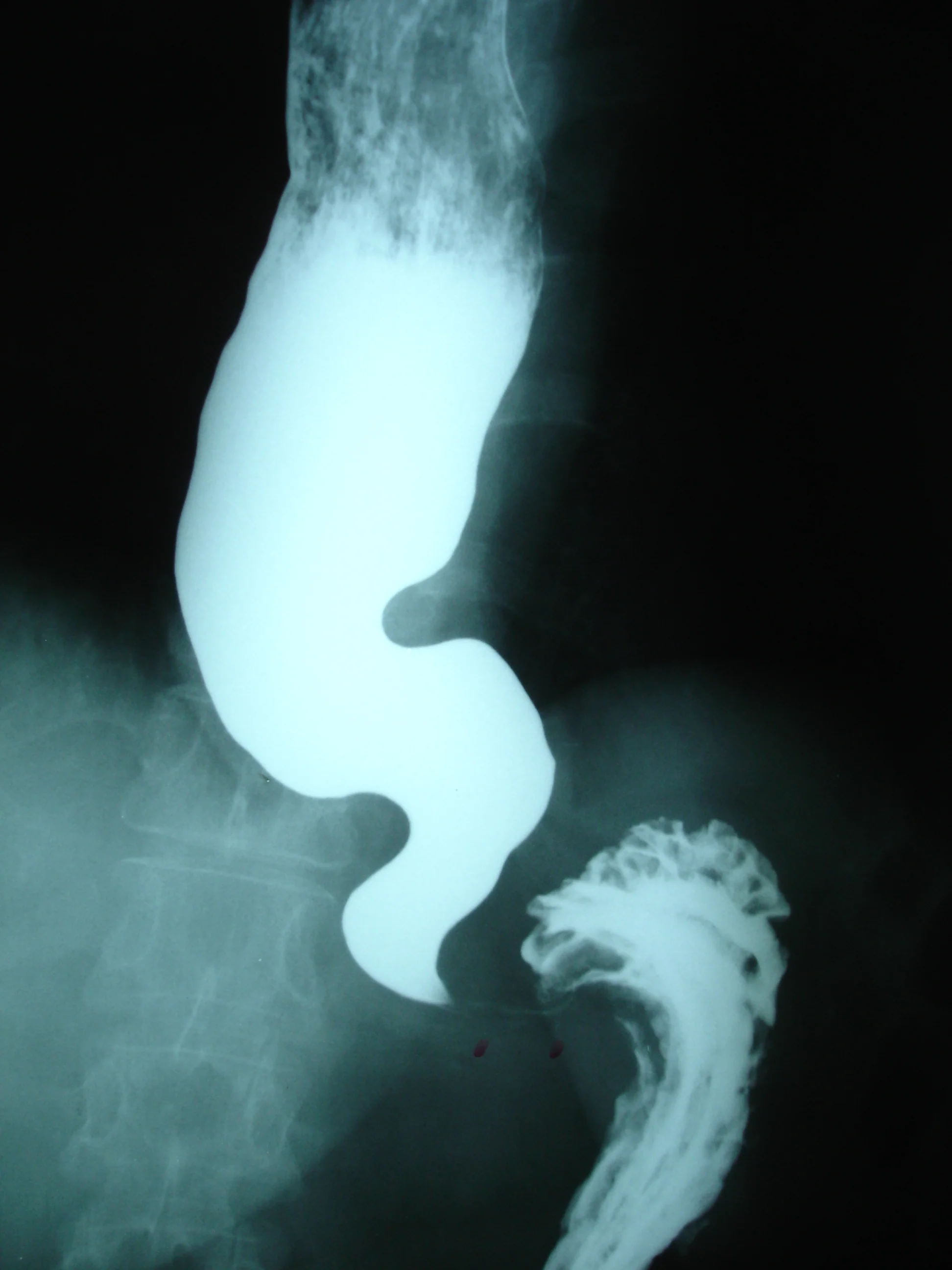 ESOPHAGEAL ACHALASIA