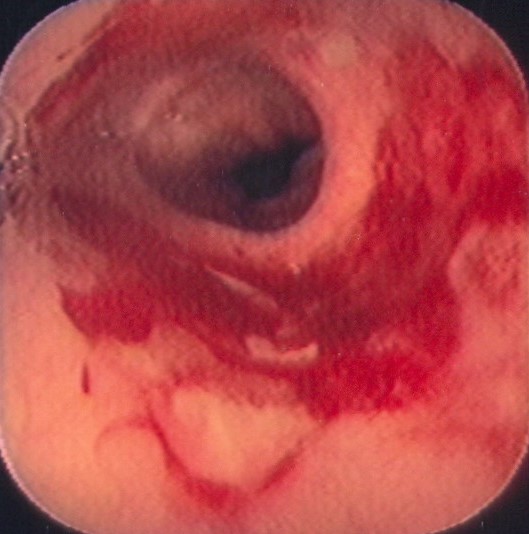 ESOPHAGOGASTRIC ANASTOMOSIS