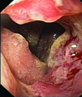 ESOPHAGOCOLIC ANASTOMOSIS