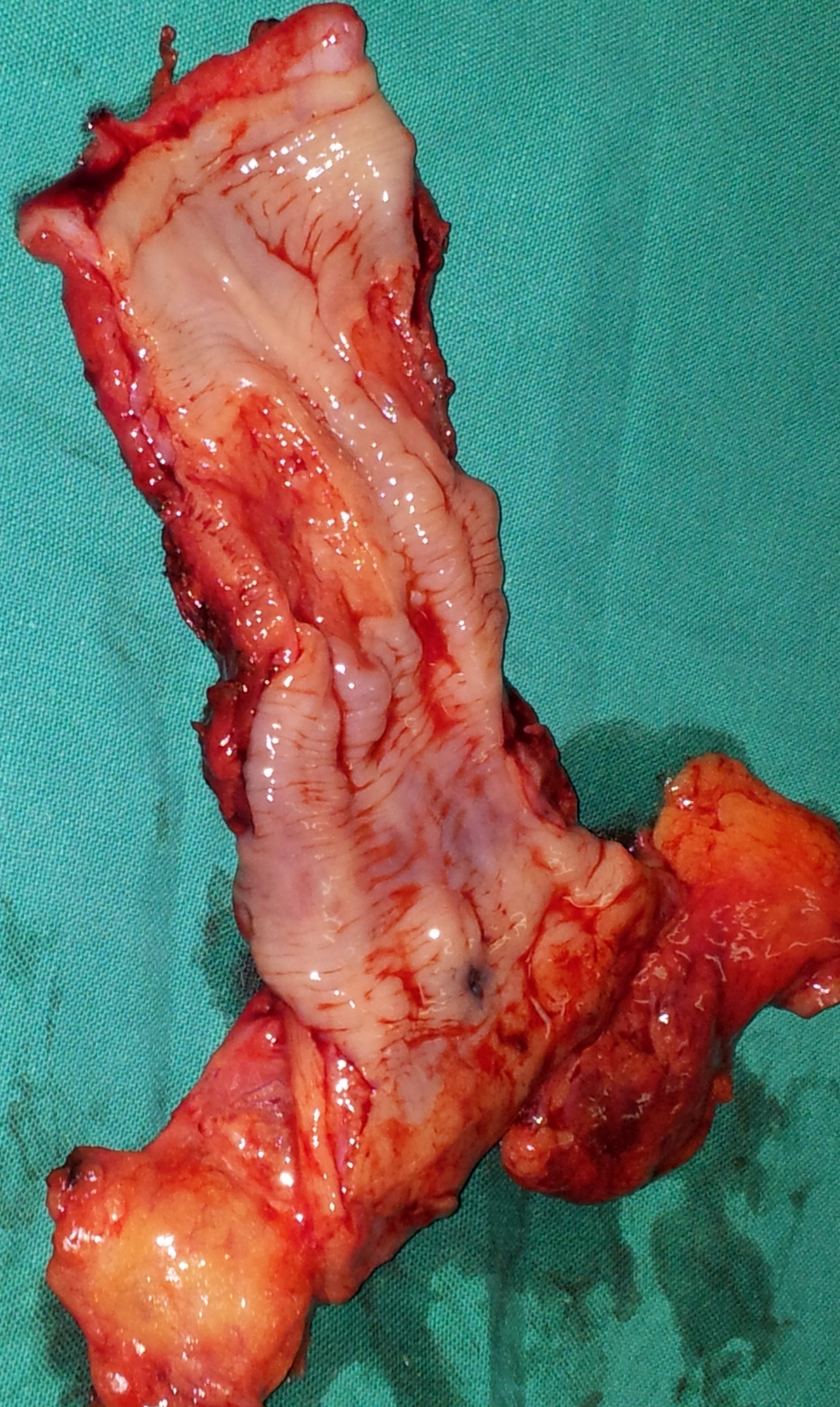 ESOPHAGEAL CARCINOMA