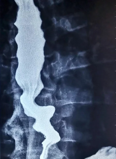 SEGMENTAL ESOPHAGEAL SPASM