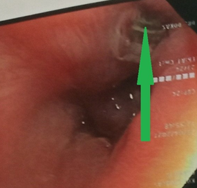 ESOPHAGEAL PSEUDODIVERTICULUM