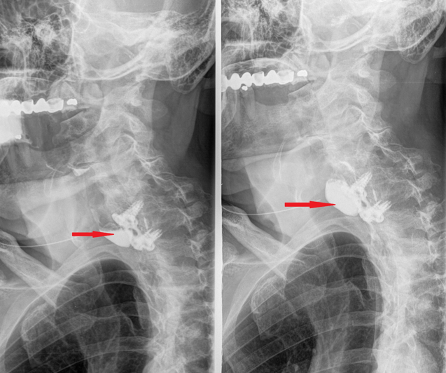 ESOPHAGEAL PSEUDODIVERTICULUM
