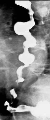 DIFFUSE ESOPHAGEAL SPASM