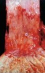 BARRETT'S ESOPHAGUS