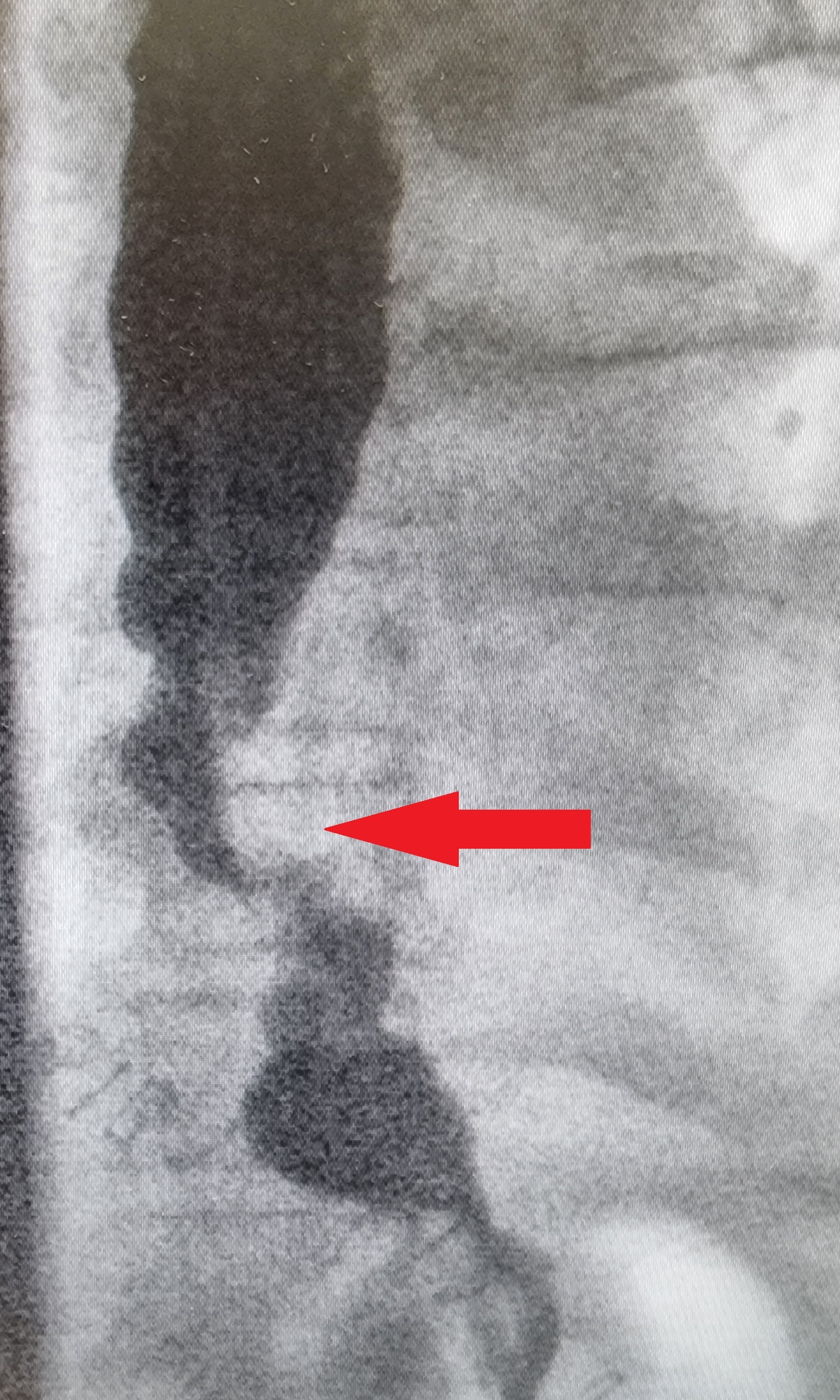 POST MYOTOMY BARIUM STUDY